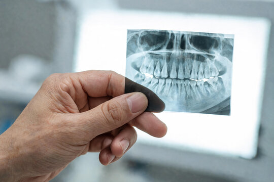 Mano de dentista sosteniendo una radiograf&iacute;a panor&aacute;mica dental en primer plano frente a un negatoscopio iluminado.