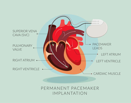 Human Heart with Pacemaker - Restoring Normal Rhythm - Stock Illustration