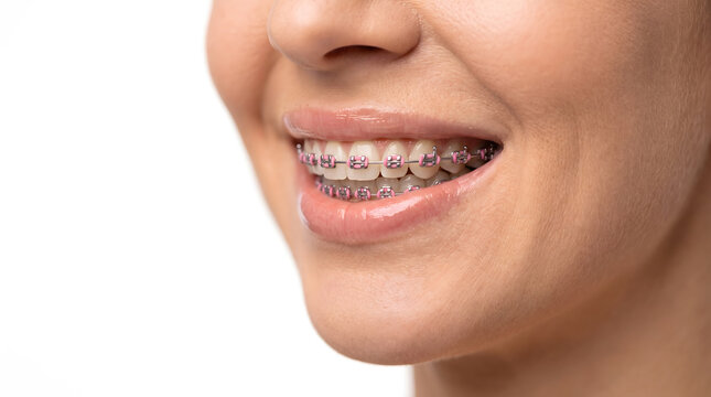 closeup smile showing metal braces on teeth for orthodontic treatment and dental alignment correction care