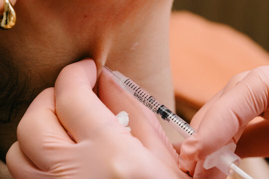 Detalle de las manos aplicando botox 