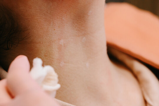 Cuello con puntos de estetica marcado 