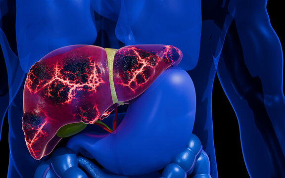Cancer Cell Growth Inside Fatty Liver Tissue Demonstrating Tumor Development, Blood Vessel Formation, Malignant Expansion, and Human Liver Disease Progression 3D Rendering
