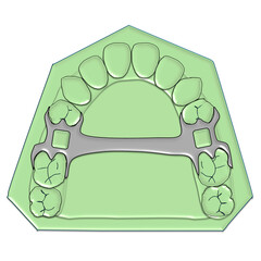 Single Posterior Palatal Bar Major Connector Illustration © Bhuvana