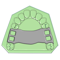 Posterior Palatal Strap Major Connector Illustration © Bhuvana