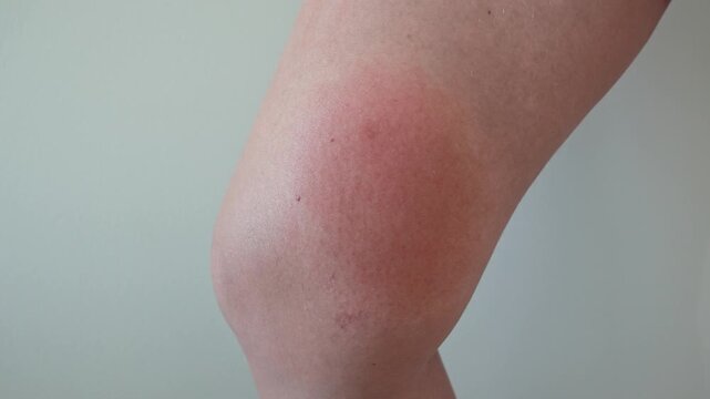 Inflamed insect bite on leg with redness and skin irritation