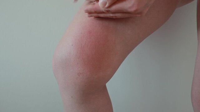 Woman applying soothing cream to swollen insect bite on knee after horsefly sting