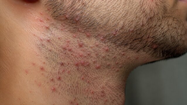Razor bumps and skin irritation on man's neck