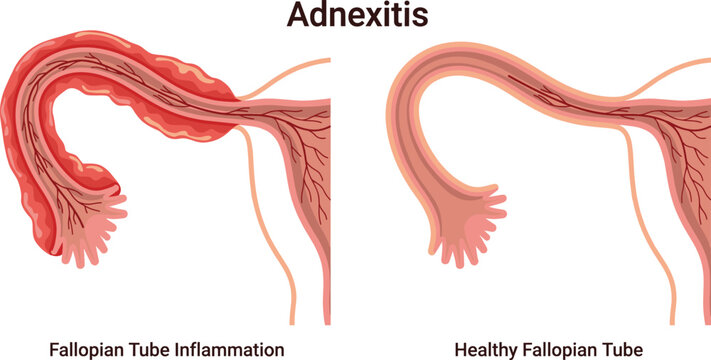 Adnexitis Medical Vector Illustration Comparing Inflamed and Healthy Fallopian Tubes with Female Reproductive System Anatomy Healthcare Educational Diagram