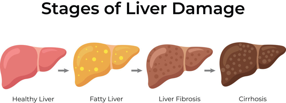 Stages of Liver Damage Disease Progression Diagram Vector.