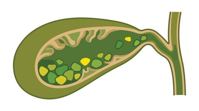 Gallbladder cross section with gallstones, medical vector illustration of cholelithiasis, human internal organ anatomy with bile duct