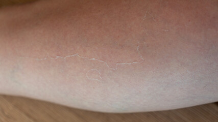 Fototapeta premium Skin peeling after sunburn. Skin problems, peeling, dead skin, epithelium. Leg