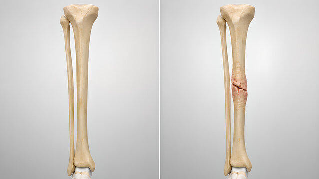 Bone fracture healing with early soft callus versus normal anatomy in a photorealistic medical illustration for orthopedic education, radiology reference, healthcare training, and patient education