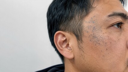 Fototapeta premium Close-up side view of adult man face with skin concern and facial hair showing natural texture