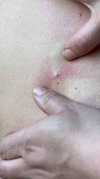 Squeezing out a huge pimple, A white sebaceous cyst.. High quality 4k footage