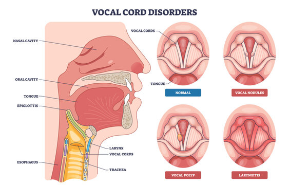 Vocal cord disorders diagram illustrating larynx anatomy and vocal cords with examples of nodules, polyp, and laryngitis, key focus, vocal cords, larynx, tongue, transparent background.