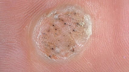 Fototapeta premium Macro of plantar wart verruca on sole of foot