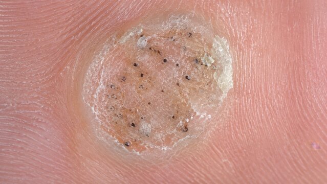 Macro of plantar wart verruca on sole of foot