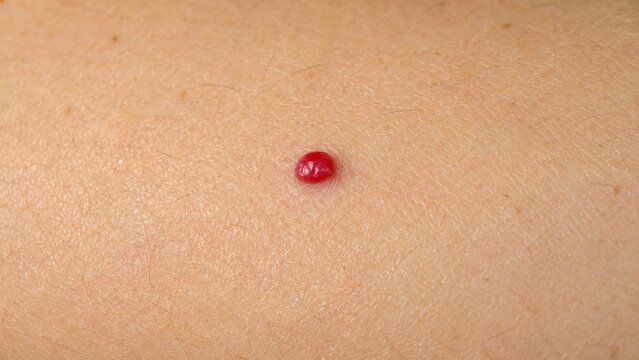 Extreme macro of a cherry angioma on human skin