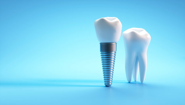 Dental implant and molar tooth isolated on blue background with copy space - 3D illustration