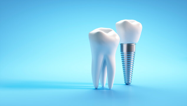 Dental implant and molar tooth isolated on blue background with copy space - 3D illustration