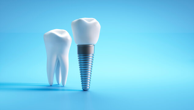 Dental implant and molar tooth isolated on blue background with copy space - 3D illustration