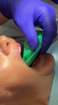 Complete dental filling procedure with patient dentist microscope anesthesia rubber dam and modern restorative treatment set. professional dental care.