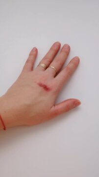 Burn on a woman hand. Selective focus.