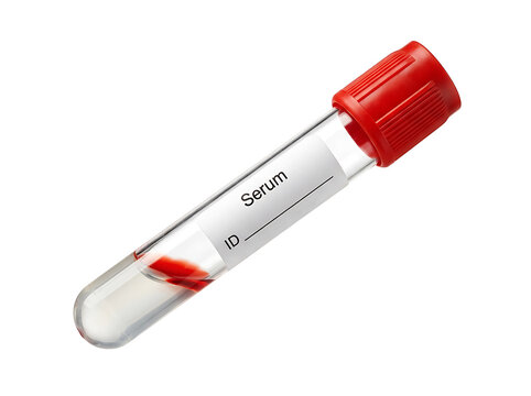 Red capped collection tube labeled serum, edta