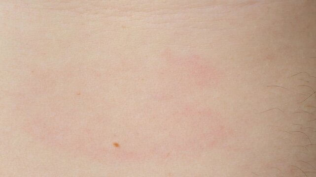 Erythema migrans rash on human skin caused by Lyme disease from a tick bite