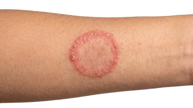 Circular ringworm tinea corporis fungal infection on forearm