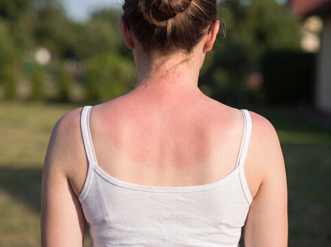 Sunburned Back and Shoulders with Visible Tan Line Contrast on Fair Skin