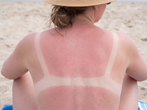 Sunburned Back and Shoulders with Visible Tan Line Contrast on Fair Skin