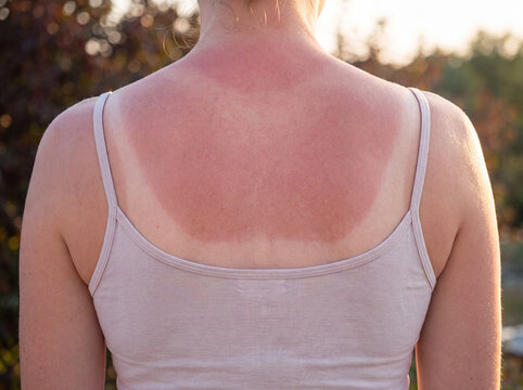 Sunburned Back and Shoulders with Visible Tan Line Contrast on Fair Skin
