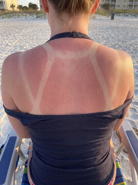 Sunburned Back and Shoulders with Visible Tan Line Contrast on Fair Skin