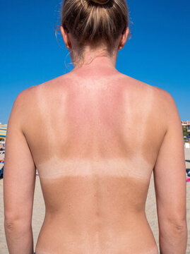 Sunburned Back and Shoulders with Visible Tan Line Contrast on Fair Skin