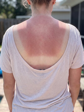 Sunburned Back and Shoulders with Visible Tan Line Contrast on Fair Skin