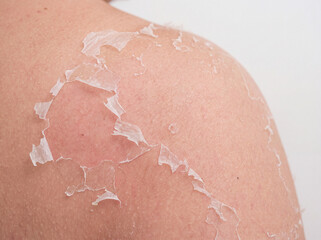 Fototapeta premium Macro Close-Up of Peeling Skin on Shoulder After Sunburn with Realistic Skin Texture