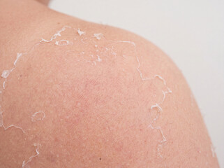 Fototapeta premium Macro Close-Up of Peeling Skin on Shoulder After Sunburn with Realistic Skin Texture
