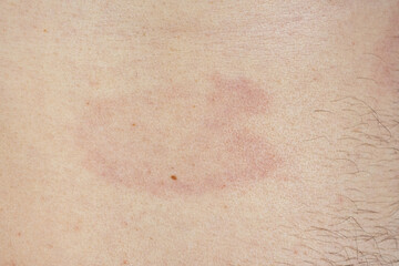 Fototapeta premium Erythema migrans rash on human skin caused by Lyme disease from a tick bite