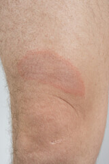 Fototapeta premium Close-up of circular red skin lesion characteristic of Borreliosis infection after a tick bite