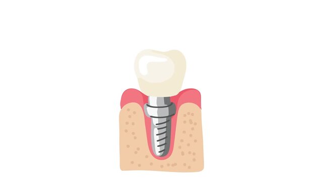 Animation of dental implant