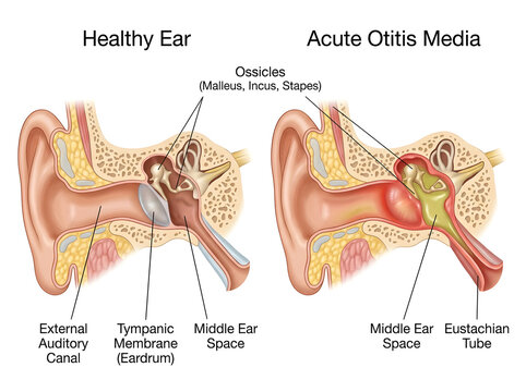 Healthy ear vs acute otitis media anatomy comparison illustration isolated on white background