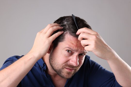 Dandruff problem. Man combing his hair on grey background