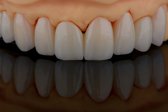 High-quality dental crowns made of zirconium for fixation to the teeth of upper jaw.