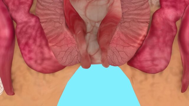 Medical Animation Of Internal And External Hemorrhoids 4K