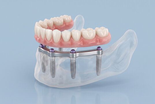 3D Medical Illustration of Implant-Supported Denture System with Transparent Jawbone Model and Prosthetic Teeth for Restorative Dentistry Education