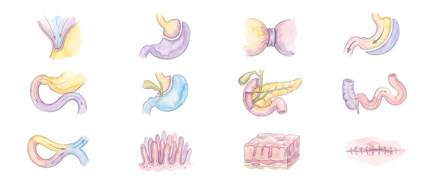 Bariatric surgery stomach anatomy diagrams showing gastric bypass, sleeve gastrectomy, gastric band, and intestinal villi. Watercolor medical illustrations set for weight loss education visual, black