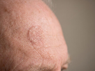 Fototapeta premium Elderly man forehead with actinic keratosis showing rough scaly sun-damaged skin patch, precancerous skin lesion dermatology concept