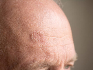 Fototapeta premium Elderly man forehead with actinic keratosis showing rough scaly sun-damaged skin patch, precancerous skin lesion dermatology concept