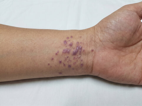 Adult wrist with lichen planus showing purple flat-topped papules on skin, inflammatory autoimmune skin condition dermatology concept